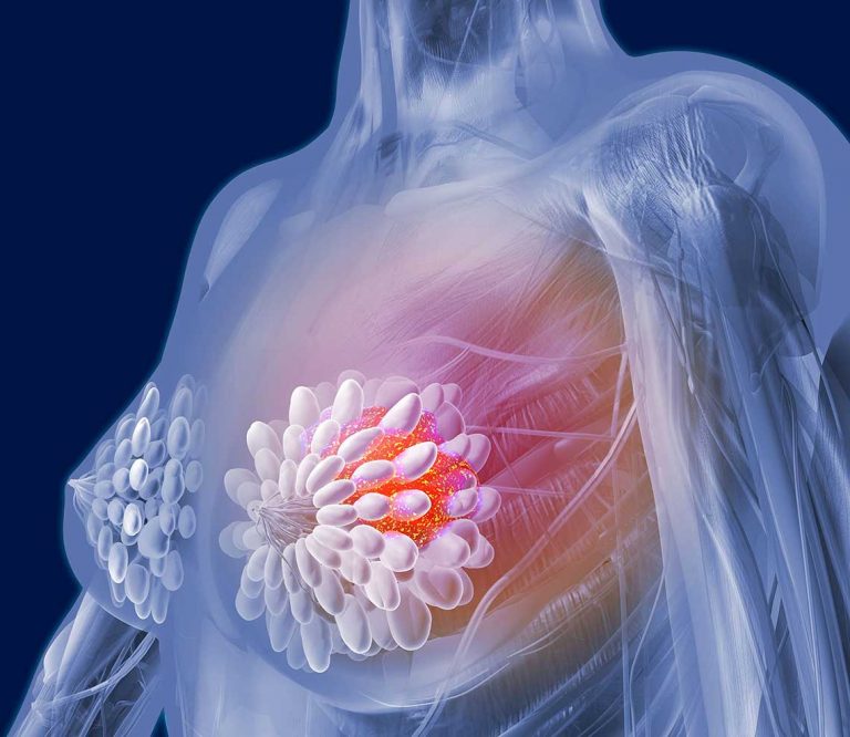New Hope for Breast Cancer